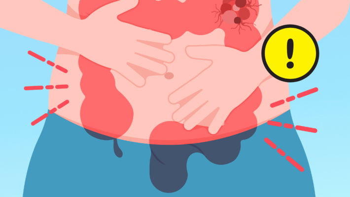 Colon cancer A deadly disease caused by unhealthy lifestyle